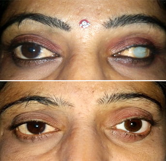 Netra Prakash Eye Center Patiala